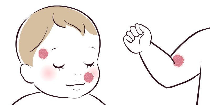 イラスト:まぶた、鼻・口付近、手足の関節付近などに症状のある方