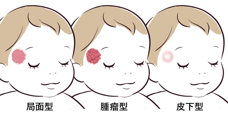 イラスト:あざごとのアプローチ