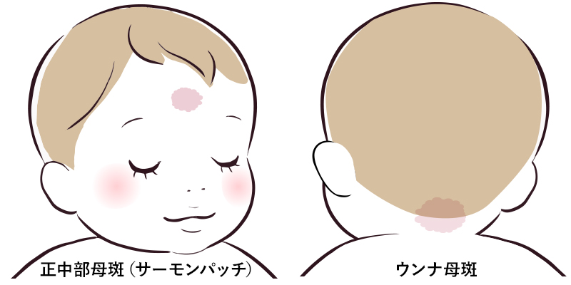 正中部母斑(サーモンパッチ)、ウンナ母斑
