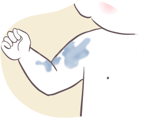 青あざ